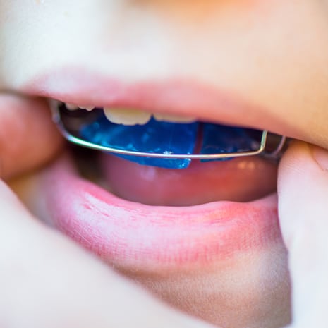 A patient gets their retainer