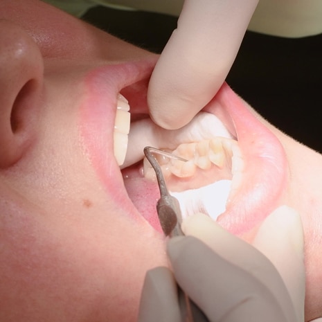 Applying resin based composite filling on tooth.