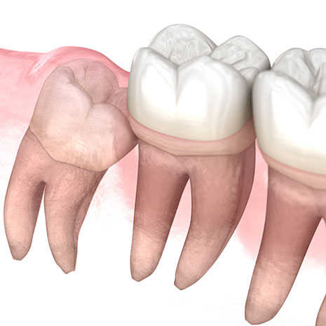 Wisdom tooth growing in mouth